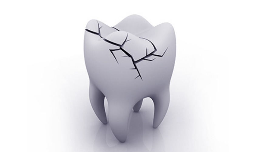 ひびや破折を発見したら歯を抜かずに修復