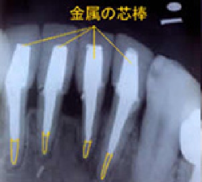 A歯科の根管治療