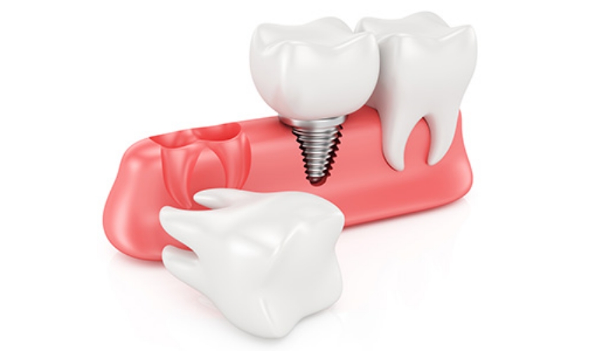 「自分の歯」を活かす「移植」という究極の治療法