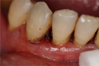 医患共同作戦で歯周病は治ります